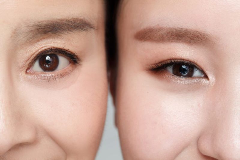 Các phương pháp giúp làm mờ sẹo sau phẫu thuật mở góc mắt trong
