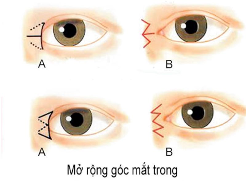 Cách chăm sóc vết mổ sau phẫu thuật mở góc mắt trong