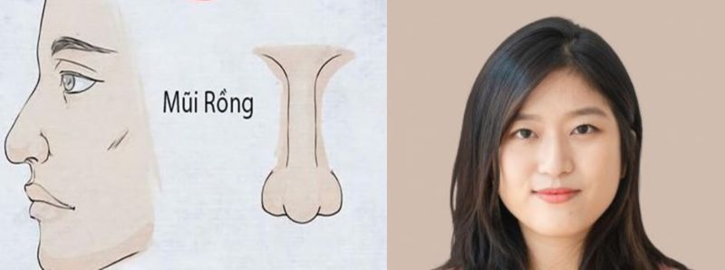 Chăm sóc mũi sau thẩm mỹ để duy trì dáng mũi rồng