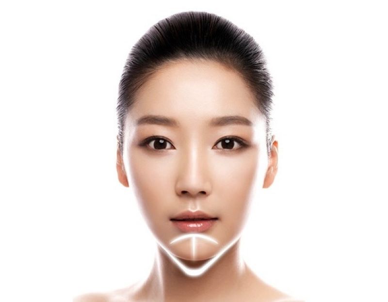 Có nên độn cằm không