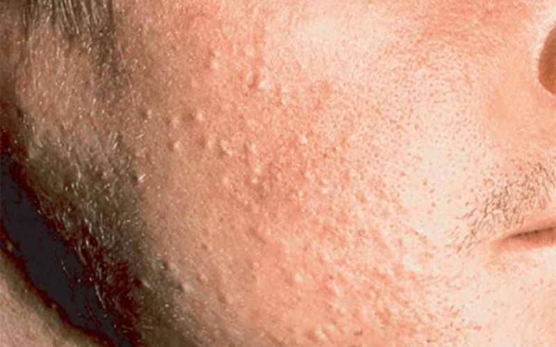 Mụn ẩn là gì và nguyên nhân gây ra