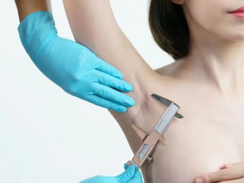 Nâng ngực đường nách là gì