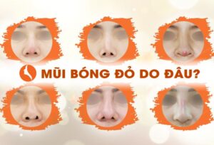 Nguyên nhân dẫn đến nâng mũi bị bóng đỏ