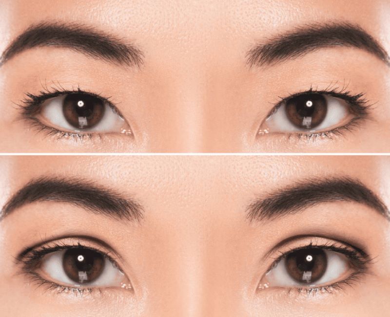 Những điều cần kiêng sau khi cắt mí