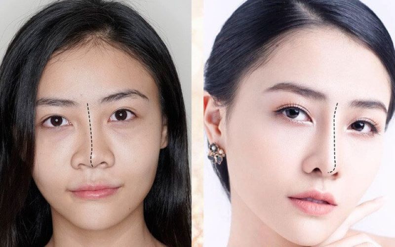 Những lưu ý khi chọn dịch vụ nâng mũi