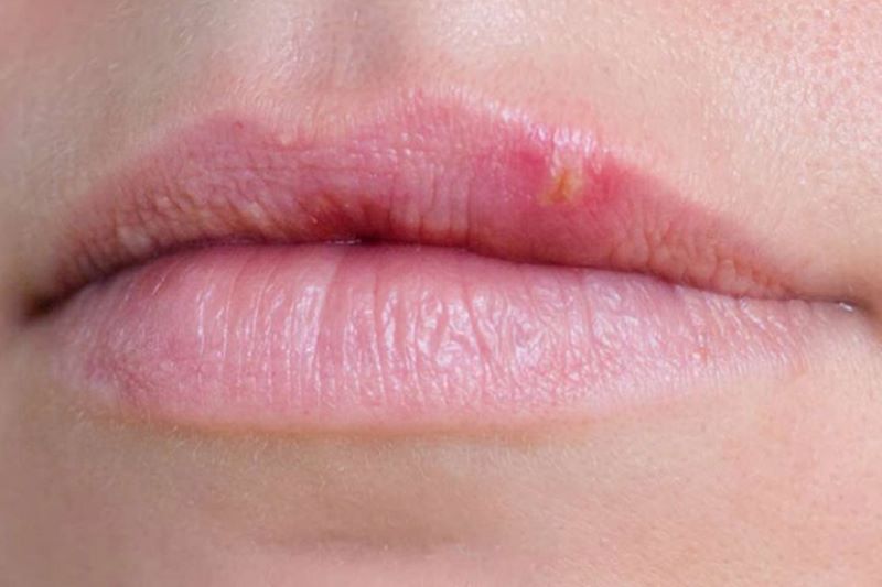 Những sai lầm thường gặp khi chăm sóc môi sau phun