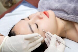 Phương pháp điều trị mụn ẩn chuyên sâu