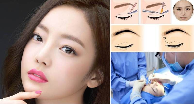 Tại sao cần chú ý đến chế độ ăn uống sau cắt mí